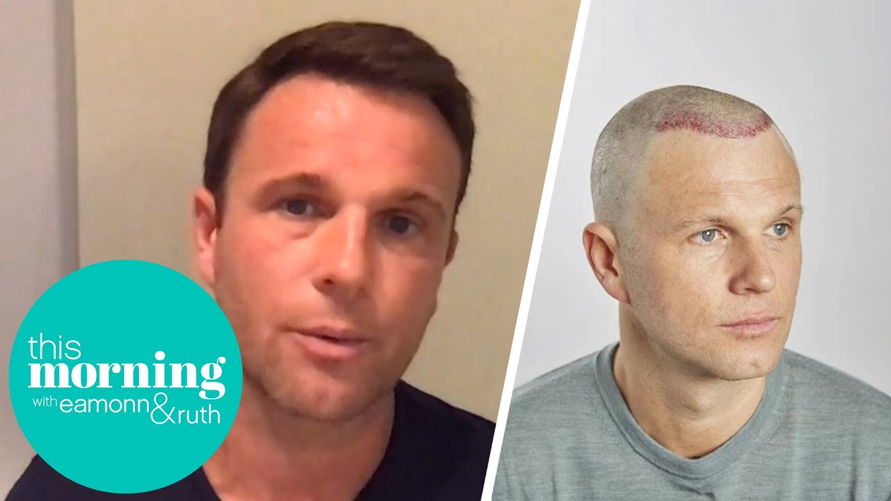 I’ve Spent £40,000 On Fixing My Botched Hair Transplant And Now I’m