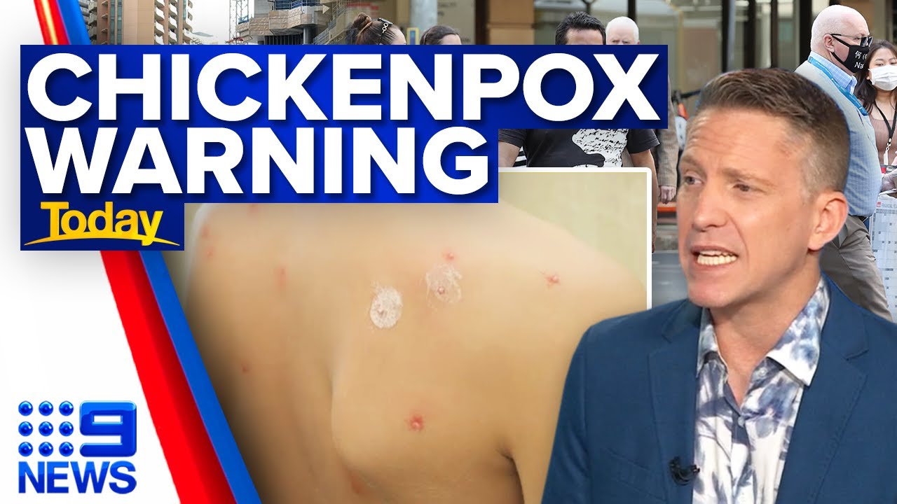 Recent Chickenpox Surge in chickenpox infections in Queensland | 9 News Australia - The ...