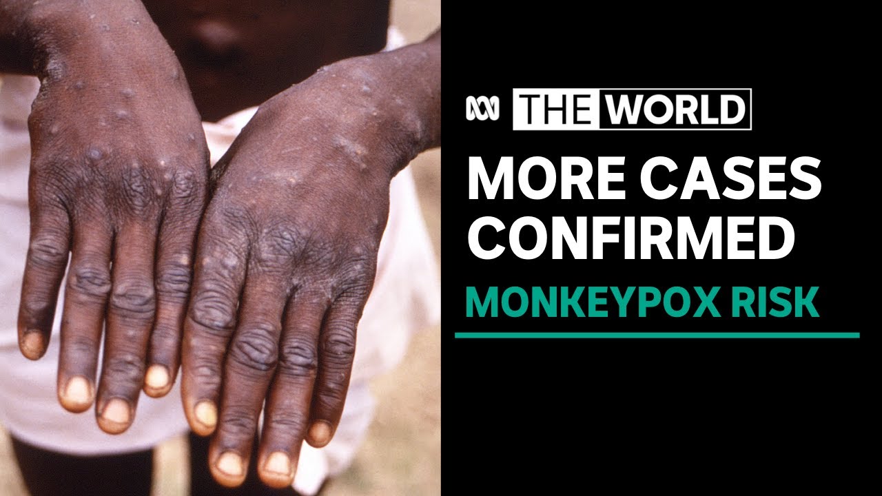 More than 200 confirmed or suspected monkeypox infections mostly in ...