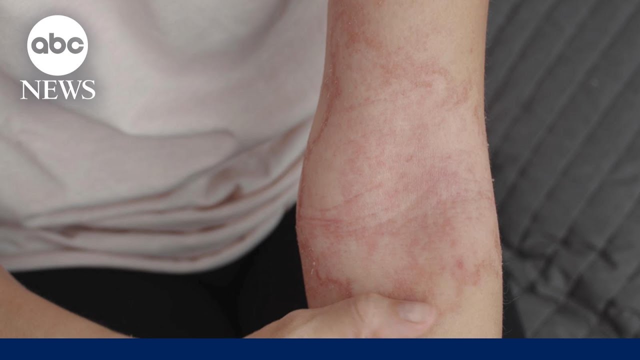 Patel It Like It Is: The best way to treat rashes and eczema during the ...