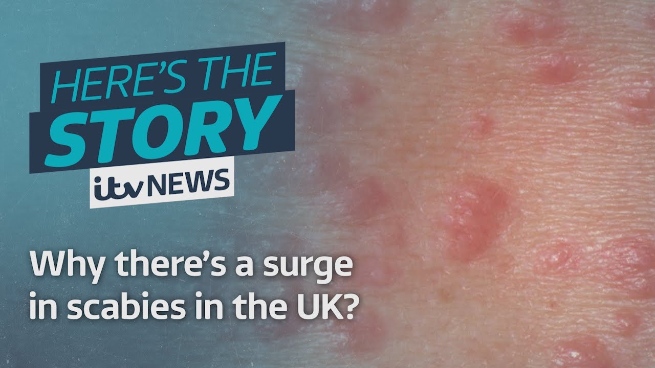Why there’s a surge in scabies in the UK? ITV News The Global Herald